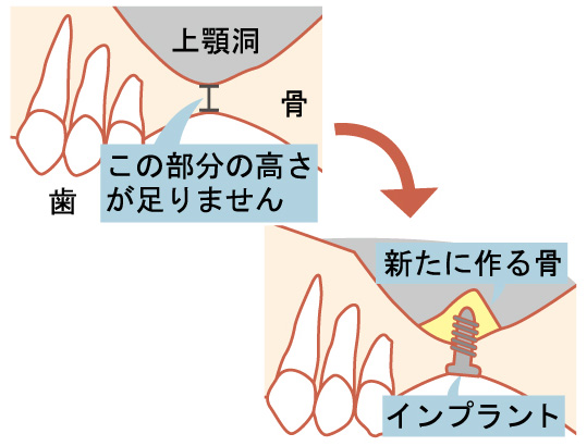 インプラント