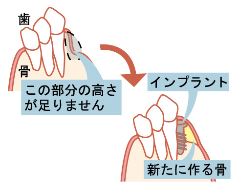 インプラント
