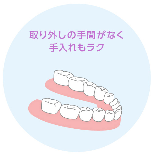 インプラント