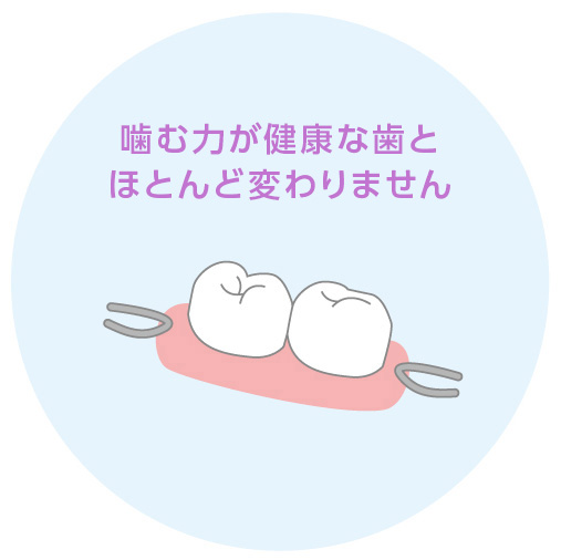 インプラント