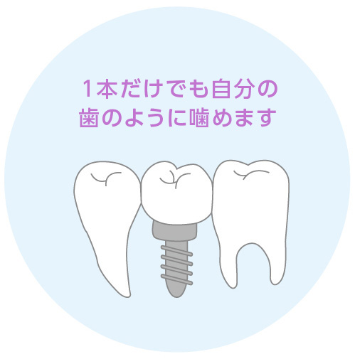 インプラント