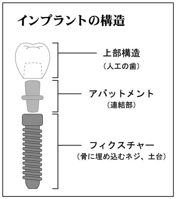 インプラント